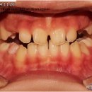 플러스치과기공소 | 반대교합 교정기 기간 후기 치과교정과전문의