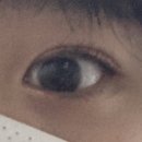 한길아산내과 | (스압주의) 생각나는대로 적어보는 갑상선항진증으로 인한 안병증/ 시신경염/ 안와감압술 후기 ++사진추가