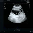 아이산산부인과의원 | 임신기록;)14주5일 다엘여성의원 성별확인!