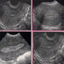 자궁내막증식증과 자궁내막암의 관계 이미지