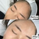 잠실피부관리 웨딩관리 | 초예민 피부에도 자극없는 3세대 스킨플래닝 세라닝 [무디 잠실본점]