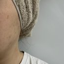 역삼-1325 | [강남/역삼] 강남 여드름흉터 알라딘필링 전문 라엘보떼 강남 역삼 피부관리 여드름흉터 강남 피부관리샵