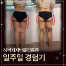 제일CC(생활용수3) | 허벅지지방흡입통증 생각보다 괜찮아서 놀랐던 1주일 후기
