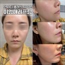 드라마틱 클래식 | 영종도피부과 덴서티 클래식 600샷 리프팅, 효과 언제부터? 통증, 주기, 금액 솔직 후기! ✨