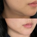 노원피부과에서 온다리프팅 4만줄 받고온 내돈내산 후기(효과, 유지기간 통증 후기)