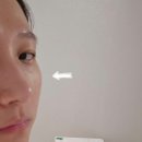 성신여대 피부과 쥬베룩 볼륨 얼굴 살없는 타입에게 완전 추천하는 내돈내산 후기