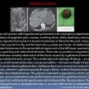 Gallstone Ileus 이미지