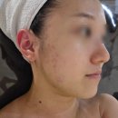 성신고려요양병원 | 성신여대 피부관리 솔직후기 여드름 압출 전후차이 미쳤다. 엠케이에스테틱 추천