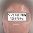 단지이것 | 가산디지털단지 한의원 추천 여드름 새살침 내돈내산 효과 부작용 색소침착 후기