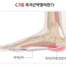 족저근막염 증상 원인 발바닥통증 발뒤꿈치통증 치료방법 이미지