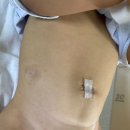서로손병원 | 담소유병원 10개월 아기 서혜부 탈장 음낭수종 수술 후기😭