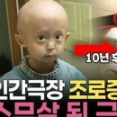 소아 조로증 원기 근황 마라톤 조로증 수명 원인 증상 치료 이미지