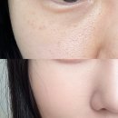 닥터이레이저피부과의원 | [내돈내산10회] 닥터이레이저 피부과 솔직후기/압구정로데오피부과/청담피부과/여드름&amp;색소침착 치료 ing