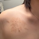 [내 돈 내산] 대전 둔산동 피부과 추천 문신(타투) 제거 후기 4️⃣