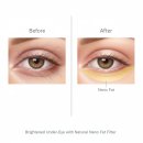 나노의원 | 지방이식 시 나노 지방이식 기술이 다크서클 교정에 효과적인 이유