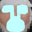 [내돈내산] 울트라 펄스 알파 여드름 흉터치료 레이저 및 다운타임 후기(강남역)
