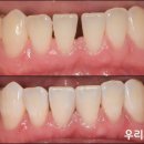 대화뿌리사랑치과의원 | 광교치과 아래 앞니 벌어짐, 치아 삭제 없는 당일 레진 빌드업 치료 방법 , 비용