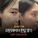 켈리의원 | 8년 달고 살았던 흑자 없앰! 신논현피부과 쁨의원 리팟레이저 후기
