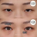 황금라인 | 쌍꺼풀수술후기, 황금라인 찾는 방법(인아웃쌍꺼풀라인)