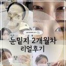 진**-2 | 눈밑지방재배치 2개월 리얼후기, 자연스러워진 눈