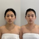 중로(보)2-1-5 | 대구신부관리 유에보에스테틱 윤곽관리 5회차 내돈내산 후기