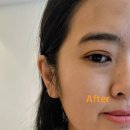 예쁨주의쁨의원 | 신논현피부과 피부장벽강화시술 필로드 예쁨주의쁨 의원 후기