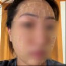 [연세보드미의원]편평사마귀 제거 관리 후기 / 듀오덤 꿀팁/ 제거 일주일 관리 방법