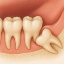 탄탄치과의원 | 당리치과 매복사랑니발치 10분만에 끝