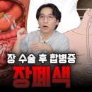 장폐색[intestinal obstruction] 이미지