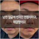 생활한문 | 부천 편평사마귀 제거 피부한의원 솔직 후기