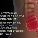 맹장염 충수염 증상 바로 알고 방치하지 말고 이렇게 대처하세요! 이미지