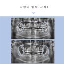 가온의원 | 옥정치과추천 안아픈 사랑니 발치 후기, 연세가온치과 -56