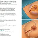 제이에스 의료기 | Quill Suture(무매듭 가시 봉합사) 시술 시 꼭 알아야 할 주의사항