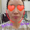 신사역 5번출구 앞 | 신사역성형외과 올타이트리프팅 나비존 개선 일주일 후기(aka. 나는솔로 순자리프팅)