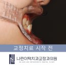 나란이턱치과교정과의원 | 인천교정치과 성장기 아이, 비수술 주걱턱 교정이 가능할까