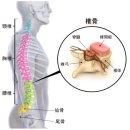 요통을 일으키는 「척주관협착증」은, 어떤 동작이 NG？ 이미지