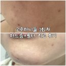 한일시멘트(주)대구공장 | 니들고주파 1회차 후기 대구동성로여드름관리 패키지 후기