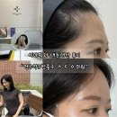 에이지의원 | 언주역 5번 출구 ㅅㄷㅇ 의원 이마필러 후기💗 스타일에이지필러 이마+관자 내돈내산!