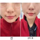 부산 서면 뉴라인성형외과 눈밑 꺼진부위 개선 쥬베룩볼륨 1회차 맞은 후기