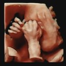 닥터황여성의원 | [27주] 입체초음파 / 태동 / 완전전치태반 / 이대목동병원 전원 전종관교수님 초진 / 증상