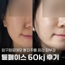 로데오로(1) | 압구정로데오 리프팅 튠페이스 60kj 일주일 솔직후기