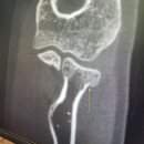 요골 | 요골, 수근골 골절 후기