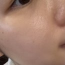 문멍 | 부산리쥬란 2cc 화명동피부과 후기 통증 멍 자국