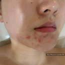 두피랑피부랑 | 대구 시내 여드름관리 '무이두피&에스테틱' 2달간 문제성피부 극복 후기(비포,애프터 ㅇ)
