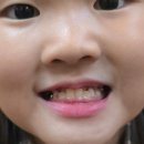 3급대한카클리닉 | 유치원 초등 아이 페이스마스크 부정교합 3급 교정 비용 기간 효과 실비 내돈내산 후기