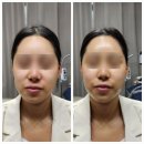 뽐뽐뷰티 | [울산남구] 울산남구피부관리 뽐뽐뷰티에서 물방울초음파 + 리프팅케어 받고 왔어요 :)