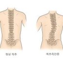 척추측만증 증상 및 원인 부터 교정 방법 정보 이미지