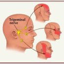 만성긴장형두통과 급성두통 (Headache) 이미지