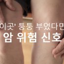 '이곳' 퉁퉁 부었다면, 암 위험 신호 이미지