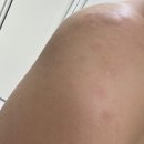 급성 두드러기 났다가 빠르게 치료한 후기